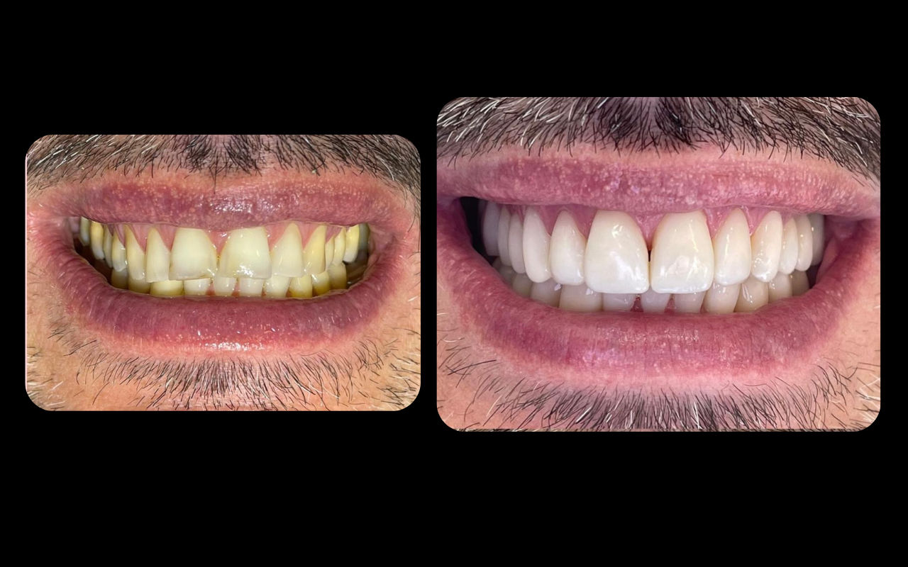 Reabilitação Estética e Oclusal realizada pela Dra. Fabiola Roggia em Porto Alegre